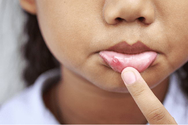 Cách phân biệt nấm miệng và nhiệt miệng ở trẻ - Ảnh 4.