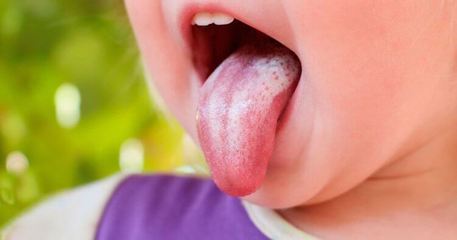 Cách phân biệt nấm miệng và nhiệt miệng ở trẻ - Ảnh 3.