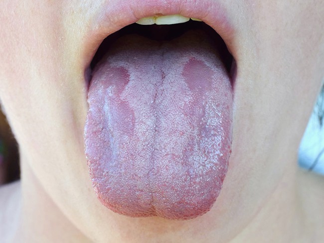 Cách phân biệt nấm miệng và nhiệt miệng ở trẻ - Ảnh 2.