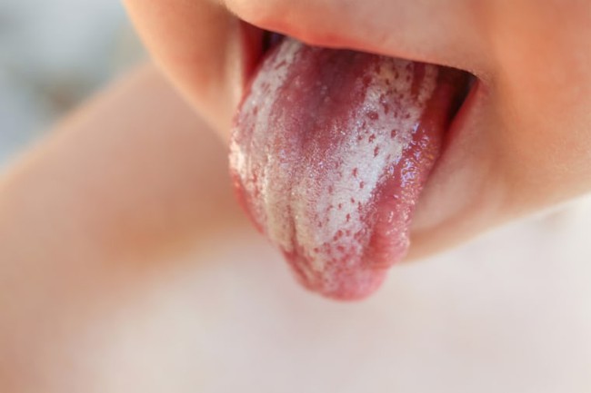Cách phân biệt nấm miệng và nhiệt miệng ở trẻ - Ảnh 7.
