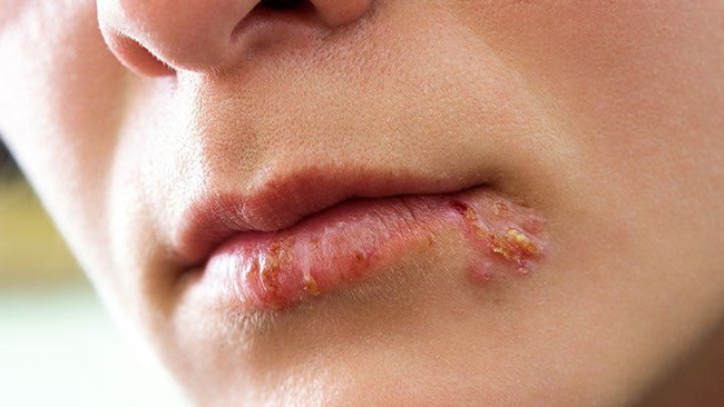 Bạn có thể bị mụn rộp do nhiễm virus Herpes khi đi bơi không? - Ảnh 2.