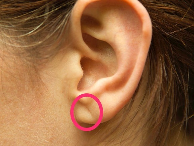 Nhìn vào đôi tai có thể tiết lộ 9 tình trạng sức khoẻ này - Ảnh 2.
