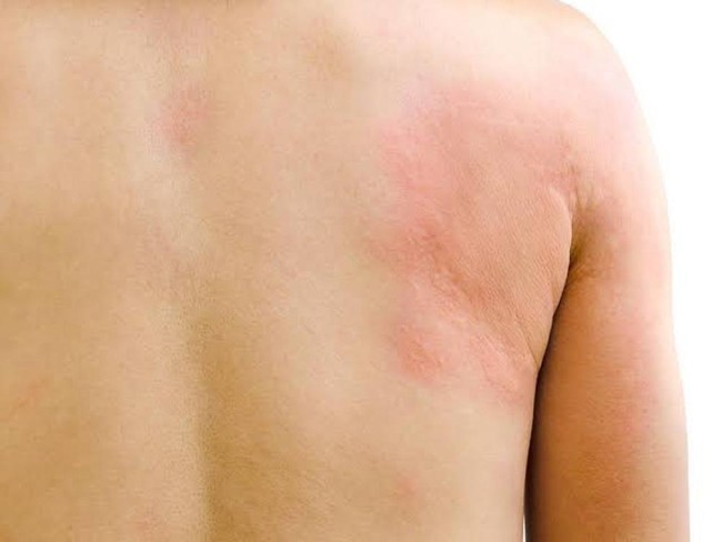Cảnh báo dấu hiệu dị ứng kem chống nắng nghiêm trọng cần khám bác sĩ càng sớm càng tốt - Ảnh 4.