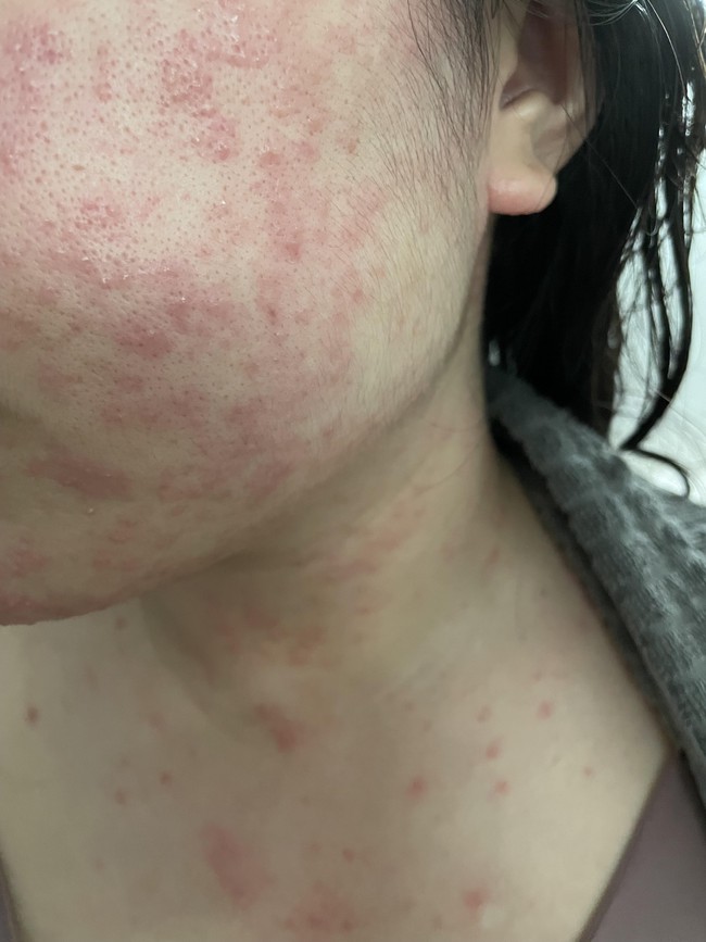 Cảnh báo dấu hiệu dị ứng kem chống nắng nghiêm trọng cần khám bác sĩ càng sớm càng tốt - Ảnh 5.
