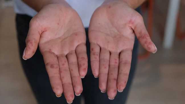 Những thông tin cần biết về bệnh tay chân miệng ở người lớn - Ảnh 4.