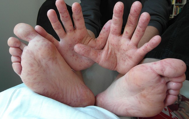 Những thông tin cần biết về bệnh tay chân miệng ở người lớn - Ảnh 2.