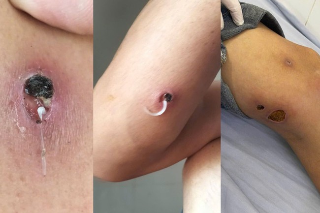 Giun rồng là giun gì? Bệnh giun rồng có chữa khỏi được không? - Ảnh 6.