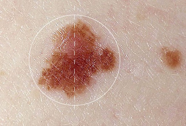 Nhận biết chính xác dấu hiệu ung thư da dựa vào sự bất thường của nốt ruồi - Ảnh 2.