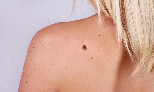 Nhận biết chính xác dấu hiệu ung thư da dựa vào sự bất thường của nốt ruồi - Ảnh 3.