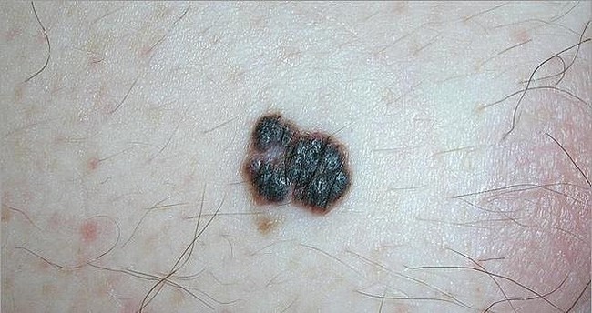 Nhận biết chính xác dấu hiệu ung thư da dựa vào sự bất thường của nốt ruồi - Ảnh 4.