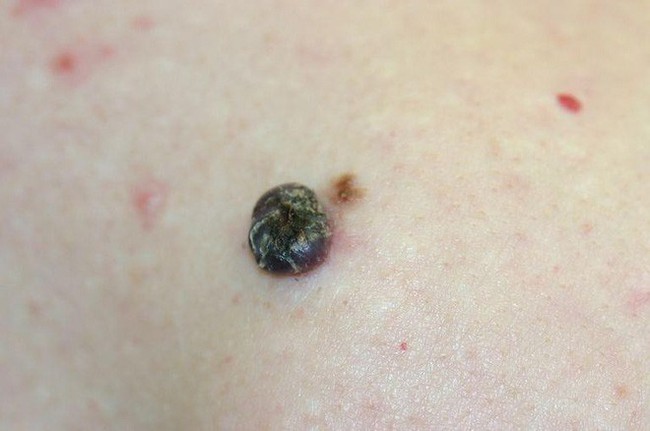 Nhận biết chính xác dấu hiệu ung thư da dựa vào sự bất thường của nốt ruồi - Ảnh 6.
