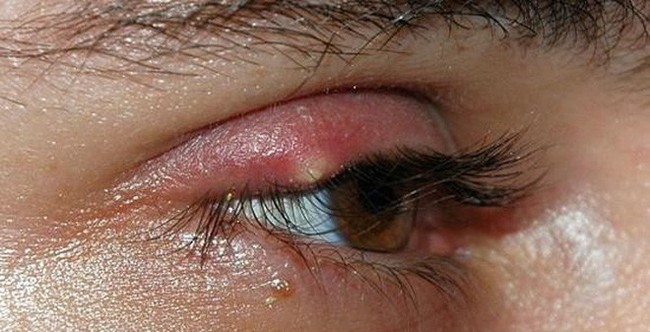 Các vấn đề nhiễm trùng mắt thường gặp trong mùa mưa cần biết - Ảnh 3.