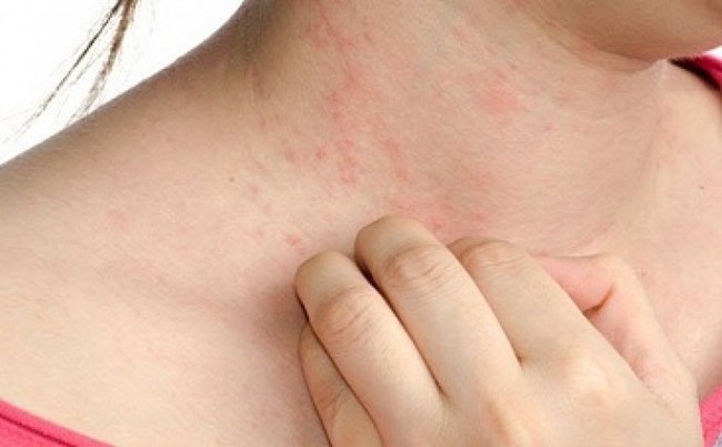 Bệnh chàm eczema là gì? - Ảnh 2.