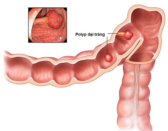 Đừng coi thường bệnh Polyp đại tràng ở người lớn nếu bạn chưa hiểu rõ về căn bệnh - Ảnh 2.