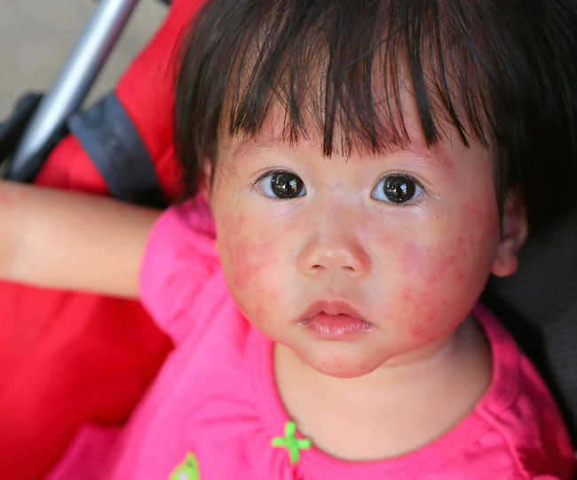 Viêm da cơ địa ở trẻ em: Nguyên nhân, triệu chứng và cách phòng ngừa - Ảnh 3.
