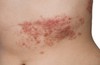 Đau dây thần kinh sau herpes(postherpetic)