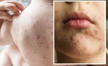 Bệnh thủy đậu ở trẻ em: Dấu hiệu sớm, biến chứng nguy hiểm và cách chăm sóc tại nhà để nhanh khỏi