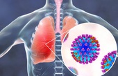 Đau ngực, khó thở, tím tái môi là một trong những biến chứng viêm phổi do cảm cúm cần lưu ý