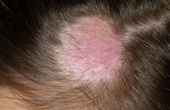 Những điều cần biết về nấm da đầu
