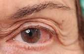 Các hướng dẫn chăm sóc giảm nhẹ triệu chứng đau mắt đỏ mà người bệnh nhất định phải biết