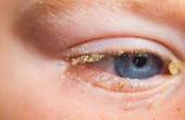 Cần làm gì khi đau mắt đỏ ngủ dậy 2 mí mắt bị dính vào nhau?