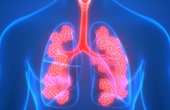 Tiêm phòng vắc-xin trong phòng tránh bệnh phổi tắc nghẽn mãn tính (COPD)