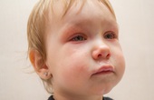 Tổng hợp các câu hỏi thường gặp về bệnh đau mắt đỏ ở trẻ nhỏ
