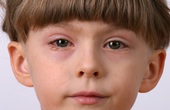 Đau mắt đỏ và tăng nhãn áp: Phân biệt bệnh để điều trị đúng cách
