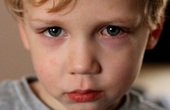 Đau mắt đỏ: Những biện pháp phòng tránh lây nhiễm từ người bệnh 