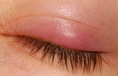 Sưng mi mắt: Đau mắt đỏ có phải nguyên nhân phổ biến nhất?