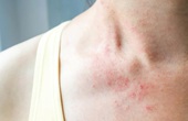 Những tổn thương khi mắc bệnh chàm và cách điều trị phù hợp