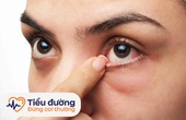Tìm hiểu những biến chứng mắt của bệnh tiểu đường