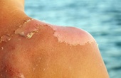 Nắng nóng mùa hè: Chuyên gia cảnh báo da bị "cháy nắng" có thể gây ung thư da