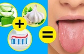 Lưỡi bị trắng do đâu? Gợi ý 7 cách làm sạch lưỡi bị trắng hiệu quả