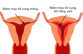 Niêm mạc tử cung mỏng là gì? Phụ nữ cần biết gì về tình trạng này?