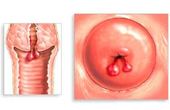 Polyp cổ tử cung là bệnh gì? Những điều cần biết về bệnh polyp cổ tử cung