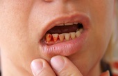 Chảy máu chân răng là bệnh gì? Những vấn đề xoay quanh tình trạng chảy máu chân răng