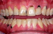 Tại sao chân răng bị đen? Điều trị tình trạng chân răng bị đen bằng cách nào?