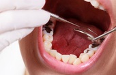 Nhổ răng ăn thịt bò được không? Chế độ dinh dưỡng sau khi nhổ răng