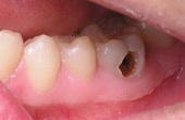 5 dấu hiệu răng bị chết tủy cần xử lý nha khoa sớm