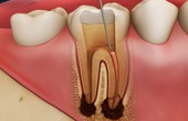 Răng chết tủy phải làm sao? Điều trị răng chết tuỷ bằng cách nào?
