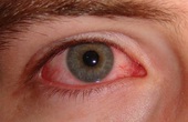 Đau mắt đỏ có lây không? Đau mắt đỏ lây qua đường nào?