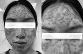 'Detox' da tại spa, cô gái bị bội nhiễm da Eczema herpeticum