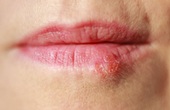 Hướng dẫn cách chữa rộp môi (Herpes môi) nhanh nhất tại nhà