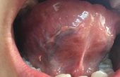 Mặt dưới lưỡi có sợi thịt là bệnh gì?