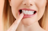 4 sai lầm thường gặp trong mùa hè dễ làm hỏng men răng