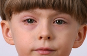 Đau mắt đỏ ở trẻ nhỏ gia tăng: Khi nào cần thăm khám bác sĩ?