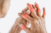 6 cách giảm đau tay do viêm khớp dạng thấp khi giao mùa