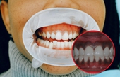 Lợi bị thâm đen: Triệu chứng, nguyên nhân và cách điều trị