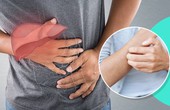 4 kiểu ngứa do ung thư gan thường bị nhầm là viêm da dị ứng, khám ngay kẻo muộn